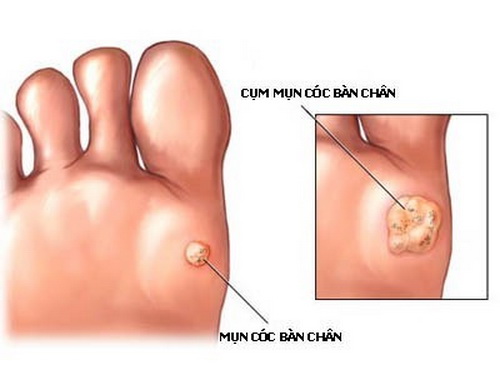 Mụn cóc gây ra bởi virus HPV.