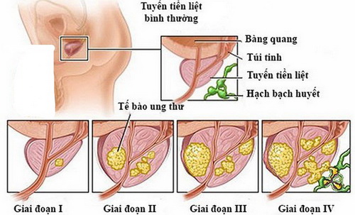 Các giai đoạn của ung thư tuyến tiền liệt.