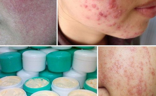 Sử dụng các sản phẩm chứa corticoid làm trắng da sẽ để lại hậu quả khôn lường.