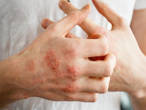 Bệnh chàm thường tái phát trong mùa lạnh.