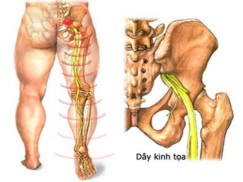 Đau dây thần kinh hông (thần kinh tọa) theo Đông y thường do lạnh (trúng phong kinh lạc) hoặc do thoái hóa cột sống gây chèn ép.