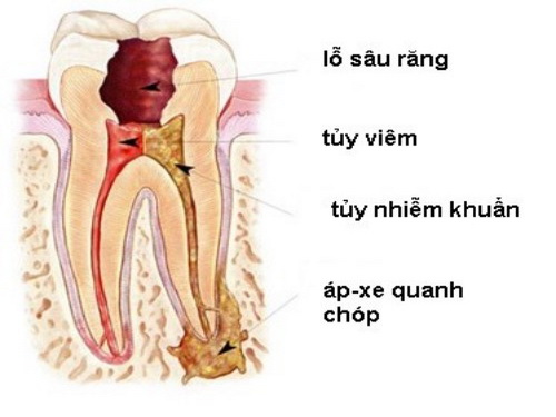 Vệ sinh răng miệng hàng ngày, đúng cách phòng viêm nhiễm hàm mặt.