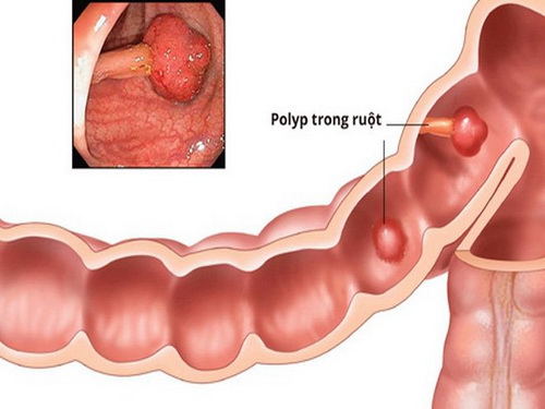 Hình ảnh polype đại trực tràng.