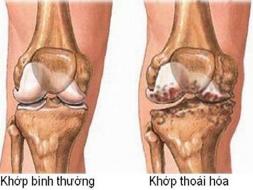 Thoái hóa khớp gối đang có xu hướng ngày càng trẻ hóa.