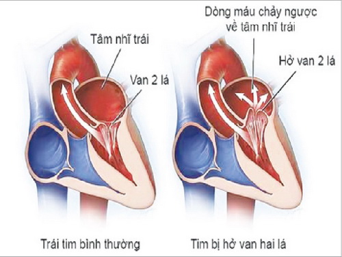 Thấp tim gây biến chứng hở van tim.