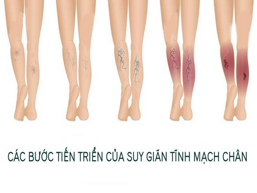 Suy giãn tĩnh mạch chân - âm thầm nhưng đau đớn