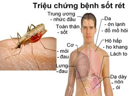 Triệu chứng của bệnh sốt rét.
