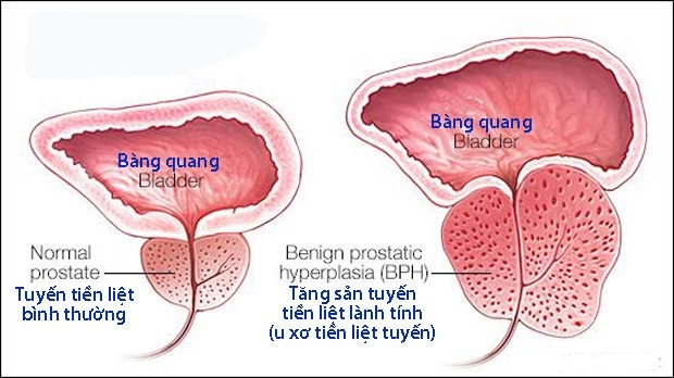 U xơ tuyến tiền liệt.