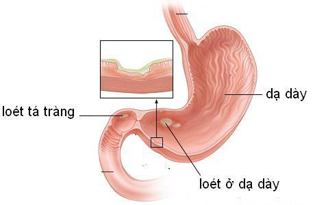 Cảnh giác biến chứng của loét dạ dày - tá tràng