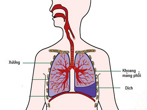 Tràn dịch màng phổi là biến chứng nguy hiểm của bệnh lao.