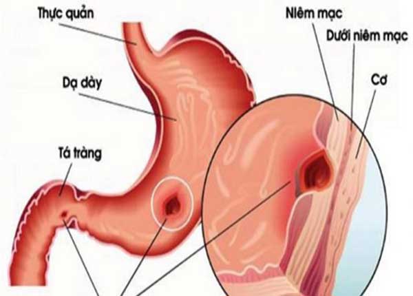 Cách nhận biết xuất huyết tiêu hóa