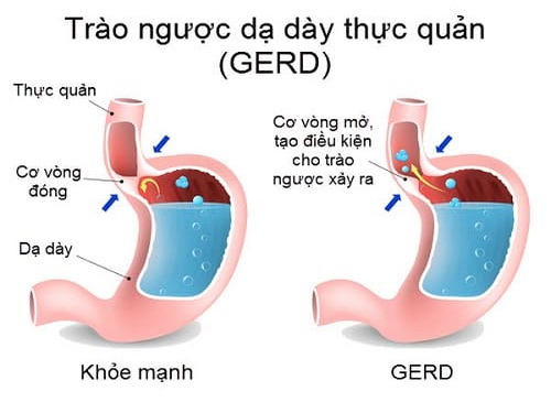 Trào ngược dạ dày thực quản là một nguyên nhân gây ho.