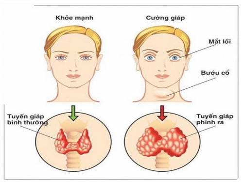 Thiếu iốt sẽ gây bệnh cường giáp.