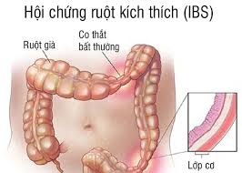 Hội chứng ruột kích là tình trạng chức năng ruột bị rối loạn.