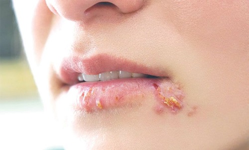 Biểu hiện bệnh mụn rộp ở môi do virus Herpes simplex nhóm I gây ra.
