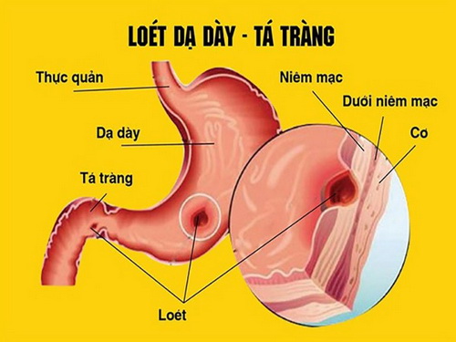 Viêm loét dạ dày - tá tràng gây nhiều khó chịu, ảnh hưởng tới chất lượng cuộc sống.
