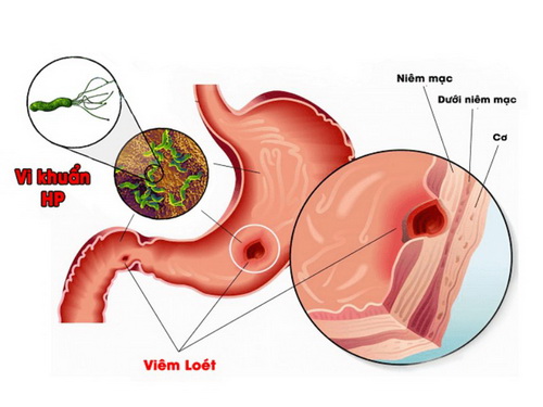 Viêm teo niêm mạc dạ dày.