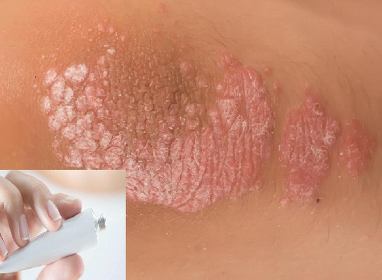 Chỉ dùng thuốc trị vẩy nến theo chỉ định của bác sĩ.