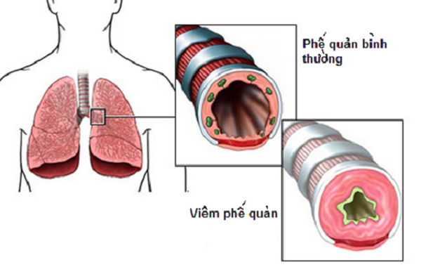 Hình ảnh viêm phế quản.