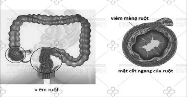 Hình ảnh viêm ruột.