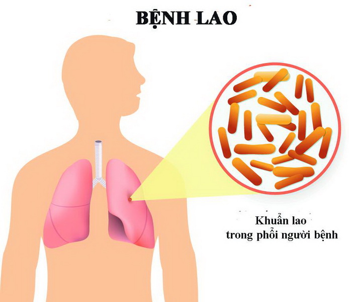 Lao phổi tái phát, nguy hiểm cận kề