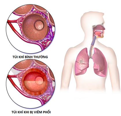 Túi khí bình thường và túi khi khi bị viêm phổi.