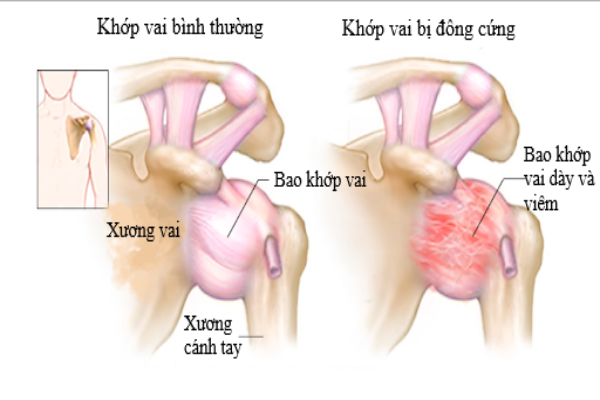 Hình ảnh khớp vai bị đau do viêm.