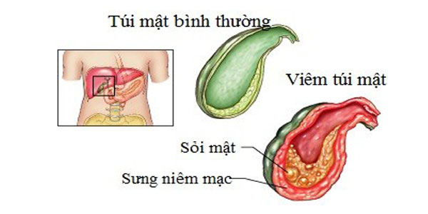 Viêm túi mật gây nhiều biến chứng.