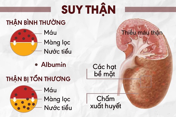 Bệnh thận mạn tính có thể tiến triển trong nhiều năm.