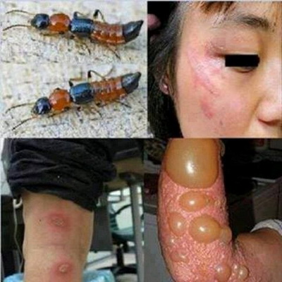 Tổn thương da do tiếp xúc với côn trùng.