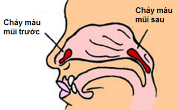 Chảy máu cam rất hay gặp ở trẻ nhỏ.