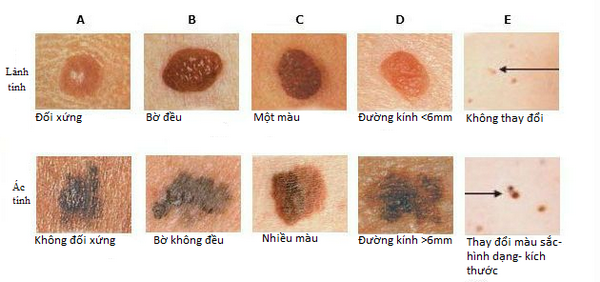 Dấu hiệu nhận biết sớm nốt ruồi ác tính