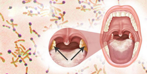Vi khuẩn Corynebacterium diphtheriae gây bệnh bạch hầu.
