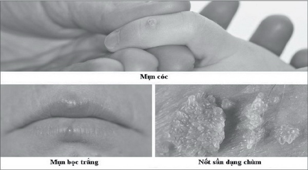 Biểu hiện của mắc virus gây u nhú ở người (HPV).