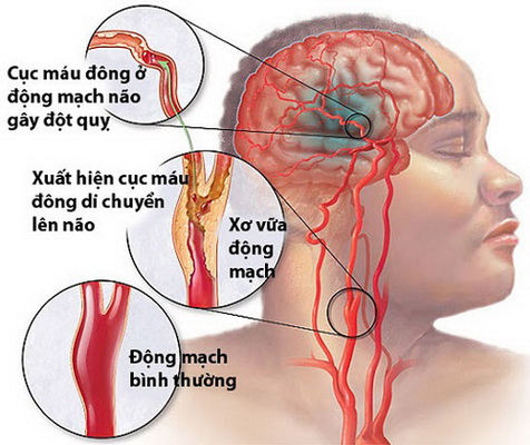 Bệnh nhân bị xơ vữa nặng các động mạch não có nguy cơ tái phát đột quỵ.