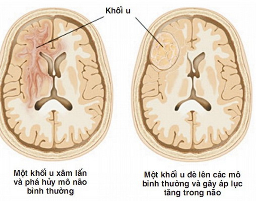 Hình ảnh u não thùy đỉnh - chẩm trái (vòng tròn đỏ).