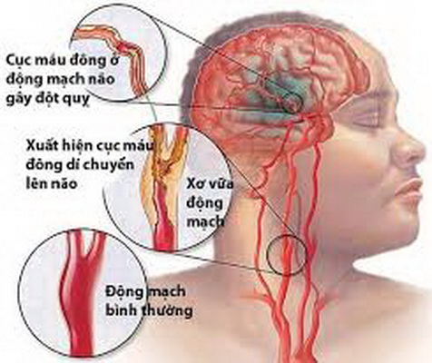 Cục máu đông - một nguyên nhân gây đột qụy.