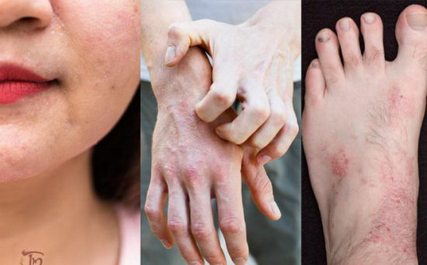 Nhận biết viêm da do ánh nắng.