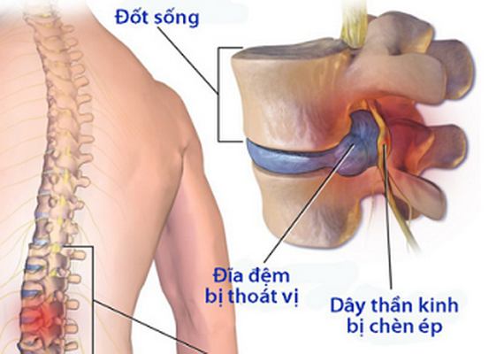 Thoát vị đĩa đệm: khi nào nên mổ?