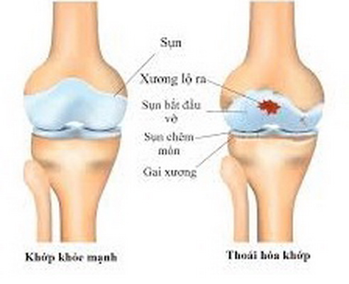 Hình ảnh khớp bị thoái hóa.