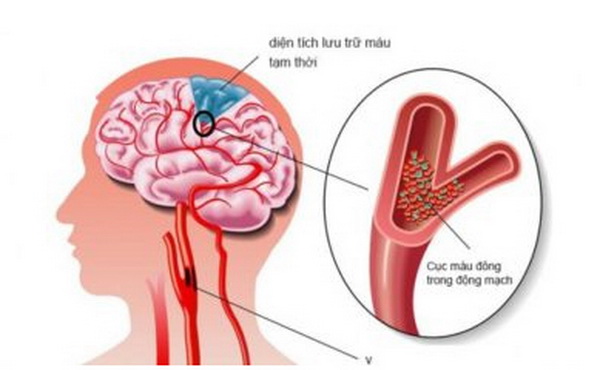 Thiểu năng tuần hoàn não cũng gây một số triệu chứng giống rối loạn tiền đình.