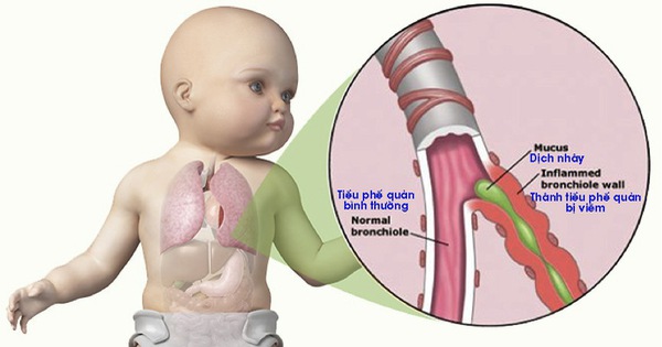 Viêm phế quản thường gặp ở trẻ em.