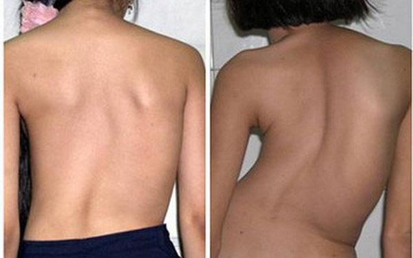 Nhận biết sớm cong vẹo cột sống và cách phòng ngừa