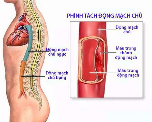 Hình ảnh phình tách động mạch chủ.