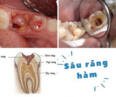 Rễ chanh kết hợp với một số vị thuốc khác giúp chữa sâu răng.