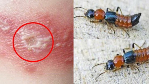 Kiến ba khoang và vết đốt.