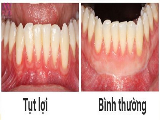 Tụt lợi là hiện tượng bờ lợi co về phía cuống răng làm hở chân răng.