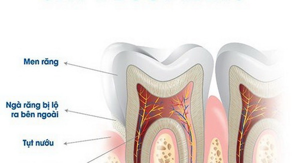 Nguyên nhân gây ê buốt răng.