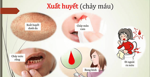 Các mức độ của bệnh sốt xuất huyết.