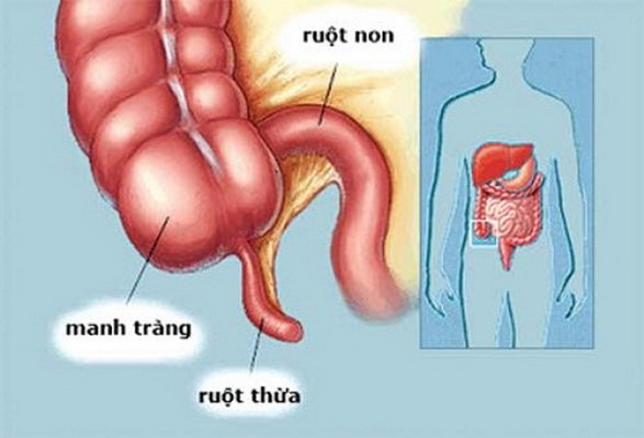 Không chủ quan với viêm túi thừa manh tràng